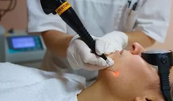 Un procedimiento efectivo para eliminar el papiloma en la cara con un láser. 