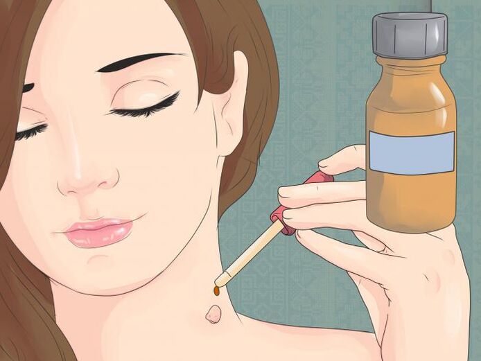 Usar el medicamento en forma de solución para eliminar el papiloma en el cuello. 