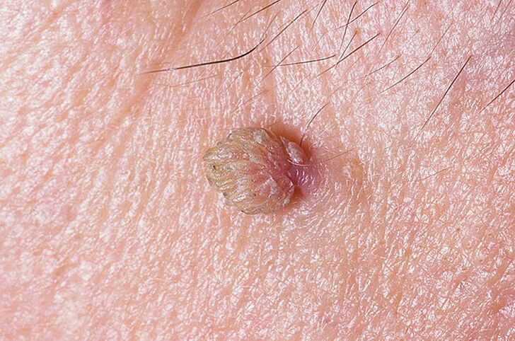 Una verruga en la piel que se puede eliminar de muchas formas. 