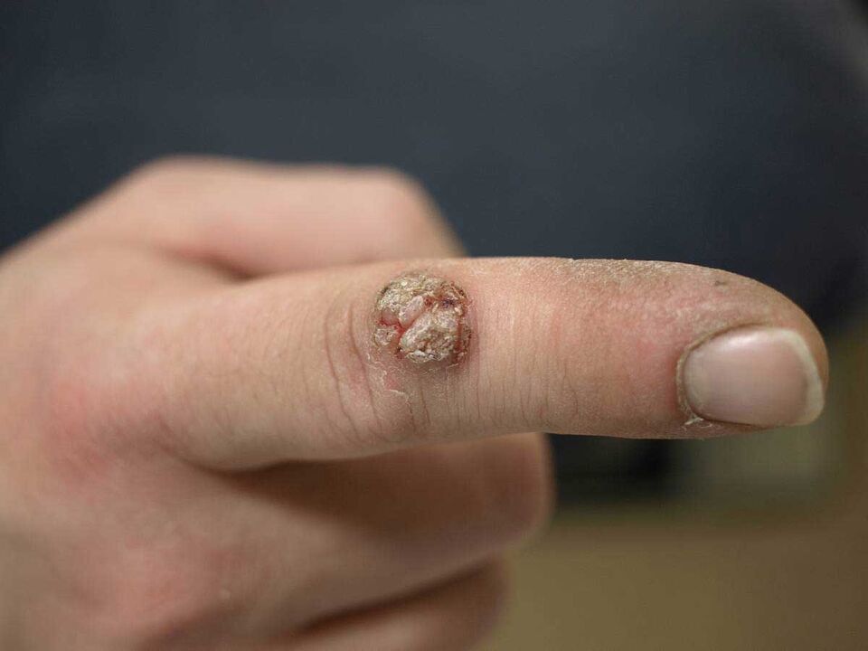 Verruga grande en un dedo que requiere eliminación
