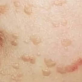 Papilomas planos