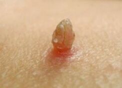 Papiloma afilado