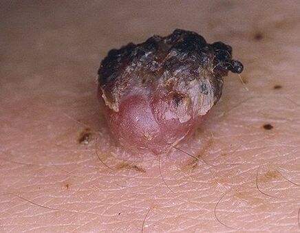 papiloma ennegrecido