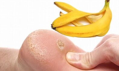 Peel de plátano para el tratamiento de una verruga plantar