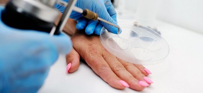 verrugas en el cuerpo humano