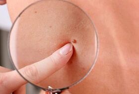 Razones de la aparición de papilomas en el cuerpo humano.