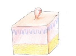 cómo deshacerse del papiloma en el cuerpo