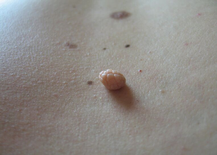 papilomas en el cuerpo humano