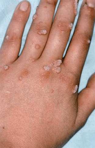 papilomas en la mano