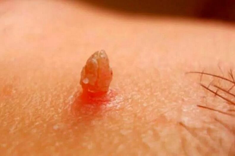 verrugas genitales en el cuerpo