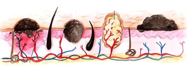 tipos de papilomas en el cuerpo humano