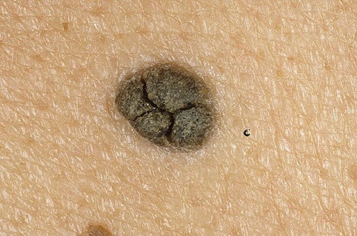 queratoma en la piel del cuerpo