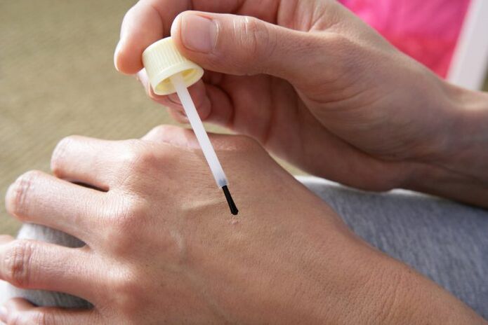 cauterización de verrugas con jugo de celidonia