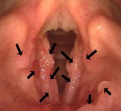 Papilomas en la laringe